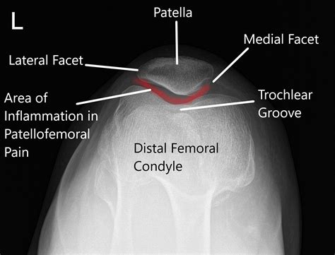 Runners Knee - New York - Dr. Nakul Karkare