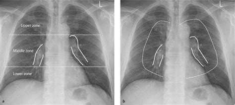 Lung and Pleura | Radiology Key