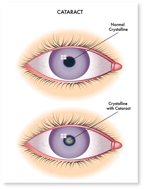 Cataract Symptoms | 1960 Eye Surgeons | Houston