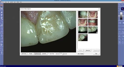 Intraoral Camera Integration with SIDEXIS 4 | Lensiora