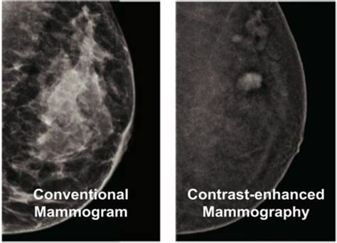 Contrast Enhanced Mammography