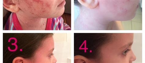 Recent Posts – Eczema Sense