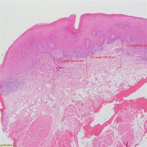 Wickhams striae on buccal mucosa | Download Scientific Diagram