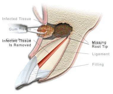 Apicoectomy at best price in Aurangabad | ID: 6349569330