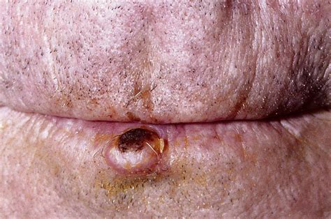 Basal Cell Carcinoma Vs Squamous Cell Carcinoma Usmle