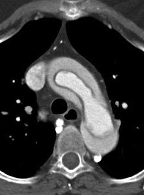 Ct Scan Aortic Dissection Longitudinal View Doccheck | Porn Sex Picture