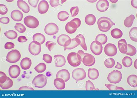 Target Cells with Abnormal Red Blood Cells in Blood Smear Stock Photo - Image of cells, health ...