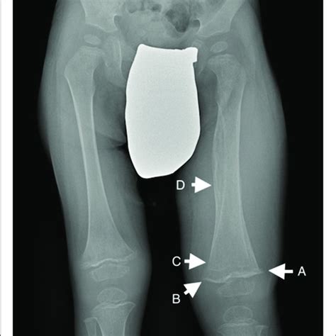 Osteopenia X Ray