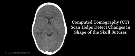 Craniosynostosis - Types, Causes, Symptoms, Diagnosis, Treatment & Prevention