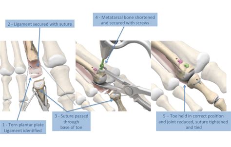 Plantar Plate Injury | Plantar Plate Dysfunction | LFAC