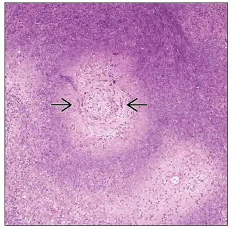 Wegener Granulomatosis | Basicmedical Key