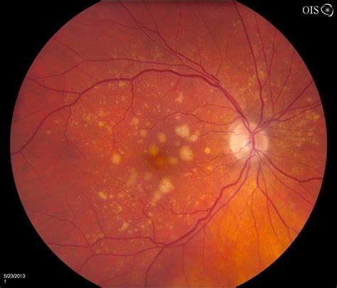 Macular Drusen - Retina Image Bank