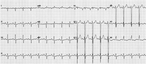 Dilated Cardiomyopathy (DCM) • LITFL • ECG Library Diagnosis