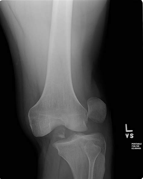 KNEE DISLOCATION | Buyxraysonline