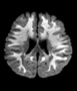 Leukodystrophy Teaching Points-MRI - Sumer's Radiology Blog