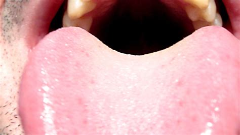 Tongue Discoloration - Your Dental Health Resource