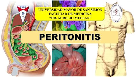 Peritonitis | Julian T. | uDocz