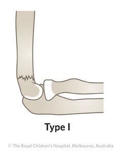 Clinical Practice Guidelines : Supracondylar fracture of the humerus ...