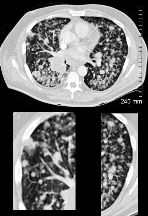 Nodules – Centrilobular | Lungs