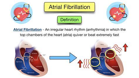 Atrial Fibrillation: Symptoms, ECG, Causes, Treatment, Definition ...