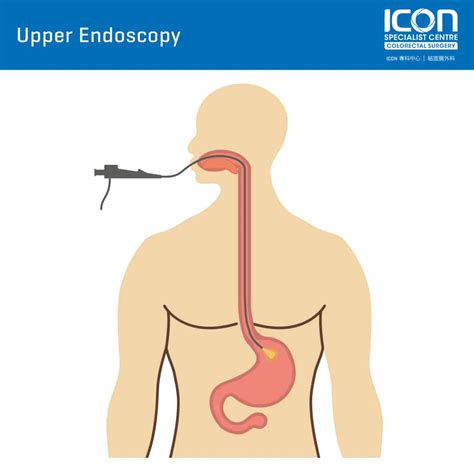 Upper endoscopy (OGD) — Icon Specialist Centre