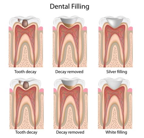 How Long Do Composite Fillings Last? - KIMIA FAMILY DENTISTRY