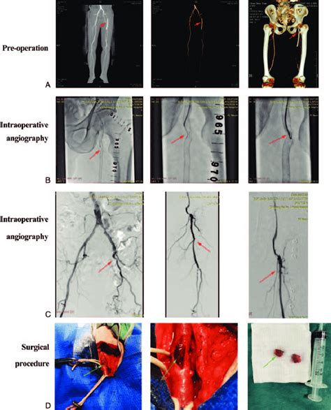 (A) Preoperative contrast-enhanced CT scan image and 3D reconstruction... | Download Scientific ...