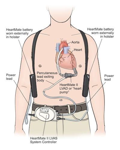 LVAD Components - REBEL EM - Emergency Medicine Blog