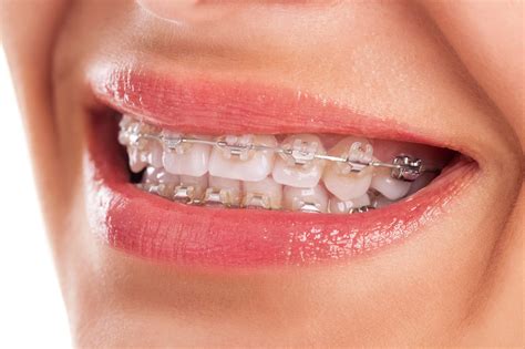 Braces or Invisalign? how to know which is right for you.