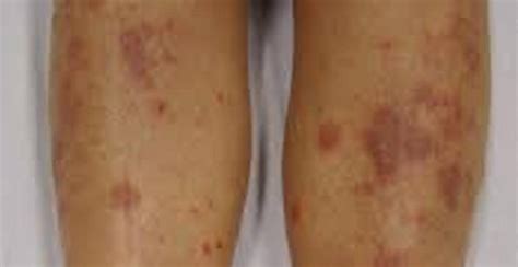 6 Ideas on How to Get Rid of Eczema Scars on Legs - Herbal Suite Blog