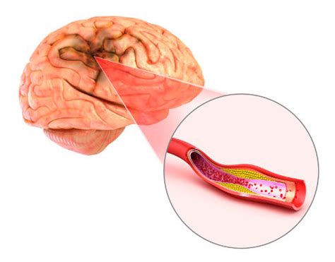 Blood Clots in Brain: Causes, Symptoms, & Treatment