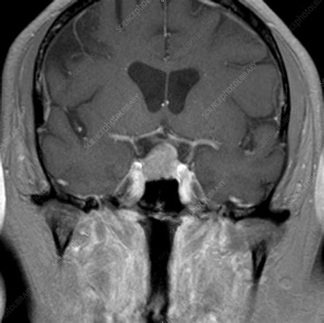 Pituitary macroadenoma, MRI - Stock Image - C039/3567 - Science Photo ...