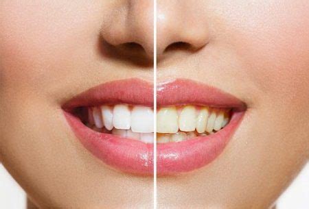 Bring Out Your Pearly Whites:Teeth Whitening - Our Guides