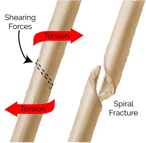 Spiral Fracture of Humerus: Signs, Treatments & Prevention | New Health ...