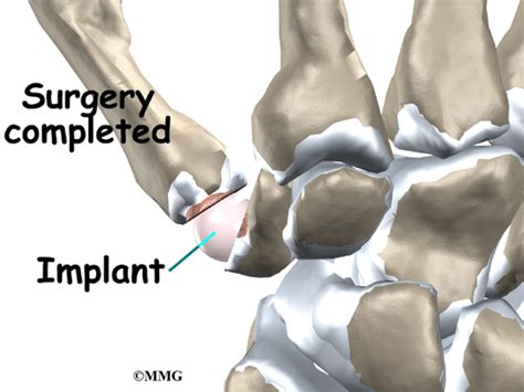 Google Password Recovery Code: Thumb Arthroplasty Recovery