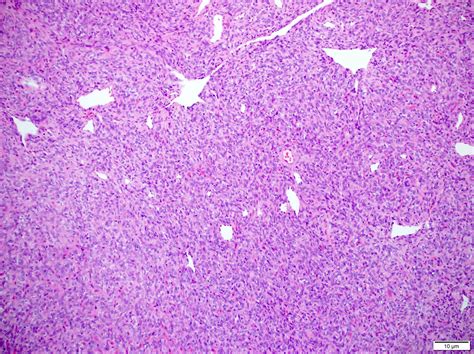 Pathology Outlines - Solitary fibrous tumor