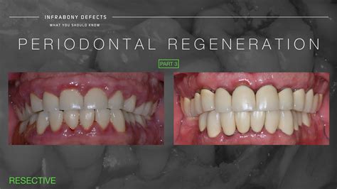 PERIODONTAL REGENERATION. PERIODONTOLOGY COURSE PART 3 - dentalsurgerychannel.com