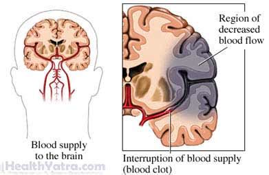 Aphasia-associated Anomia Definition, Causes, Symptoms, Complications and Cost Surgery Treatment ...