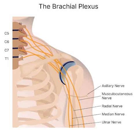 Brachial Plexus Injury - Everything You Need To Know