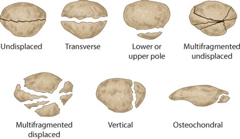 Patellar fractures | Musculoskeletal Key