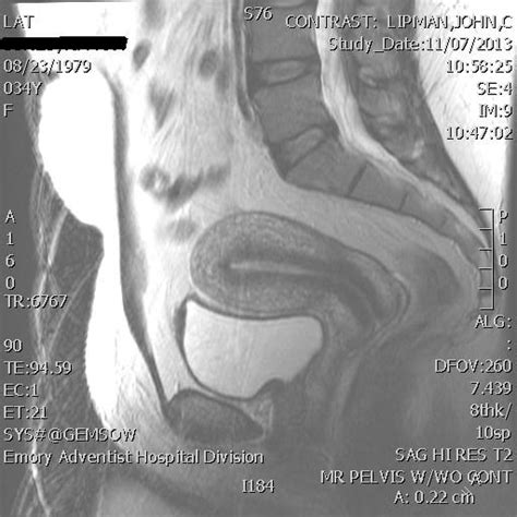 Normal Female Pelvic Mri