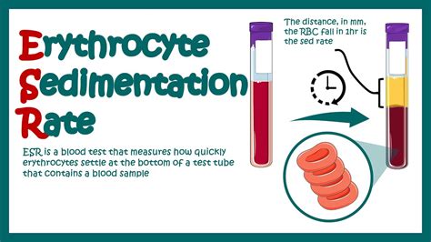 Erythrocyte Sedimentation Rate | ESR | What does ESR test show?| What ...