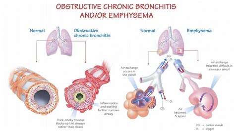 Managing COPD flare-ups - Hamilton Health Sciences