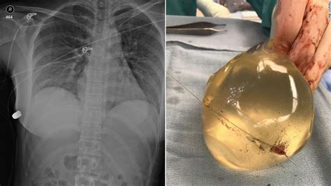 Woman's breast implant deflects bullet, saving her life - CNN