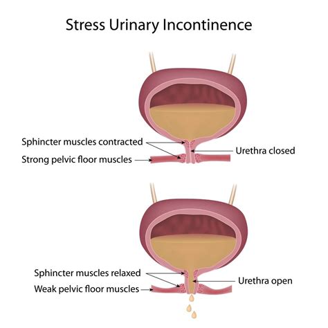 pelvic-floor-stress-incontinence - Incontinence UK