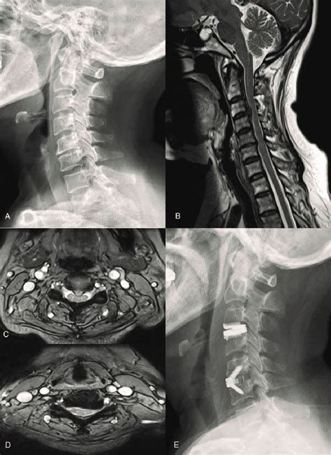 A 47-year-old man diagnosed with disc herniation at C3-C4 and C5-C6 ...