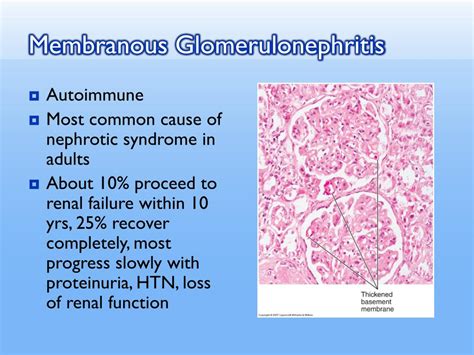 PPT - Glomerulopathies vs. Glomerulonephritis PowerPoint Presentation, free download - ID:3303528