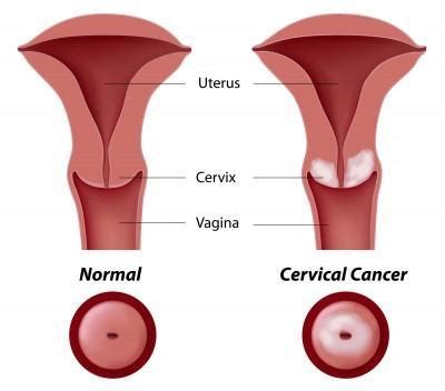 Colposcopy and biopsy - Newport Beach, CA & Irvine, CA: OBGYN CARE