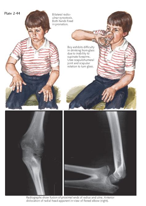 CONGENITAL RADIOULNAR SYNOSTOSIS - pediagenosis