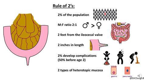 Meckel’s Diverticulum - YouTube